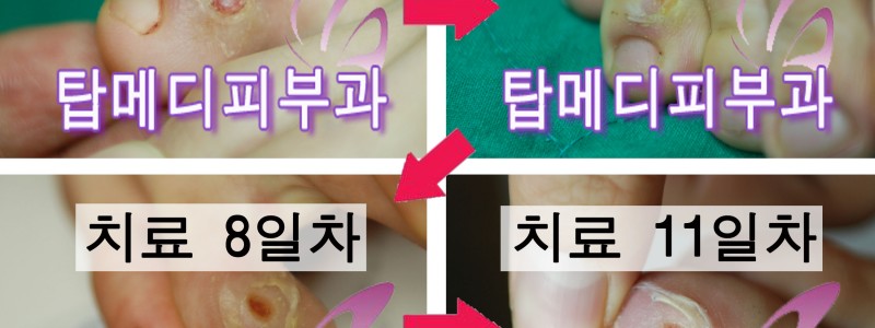 타병원에서 티눈제거를위해 레이저 치료…