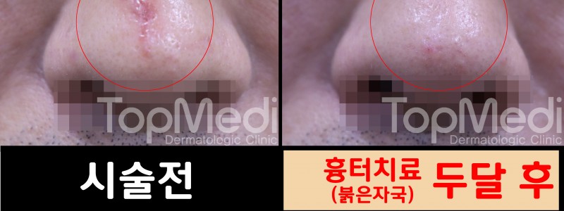 붉은흉터레이저치료